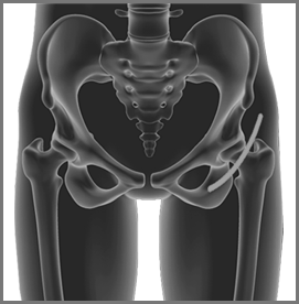 Anterior Hip Replacement