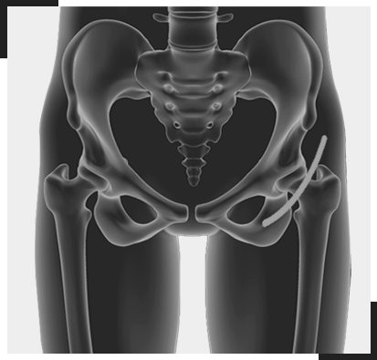 Anterior Hip Replacement